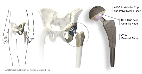 Hip Replacement Information for Patients