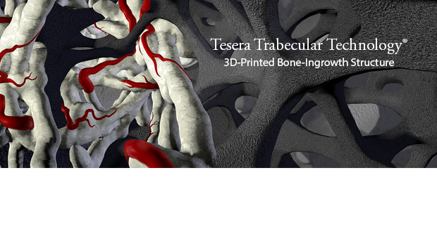 Tesera Trabecular Technology